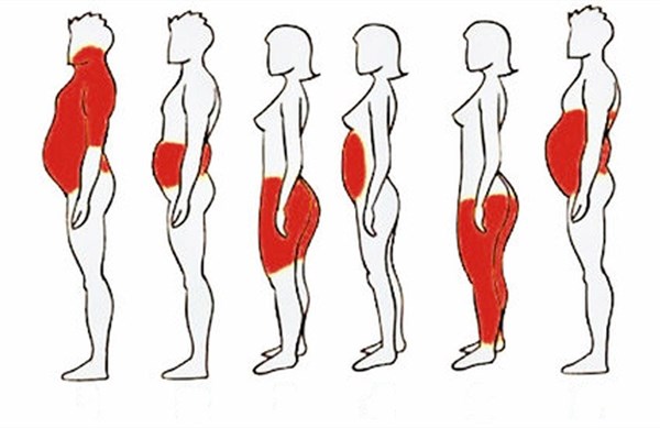 肥胖的类型.jpg